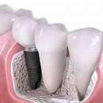 Implantati kot odlični nadomestki zobe korenine